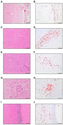 Neuropathology in COVID-19 autopsies is defined by microglial activation and lesions of the white matter with emphasis in cerebellar and brain stem areas